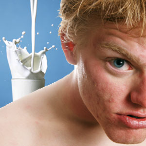 milk-good-for-acne-1